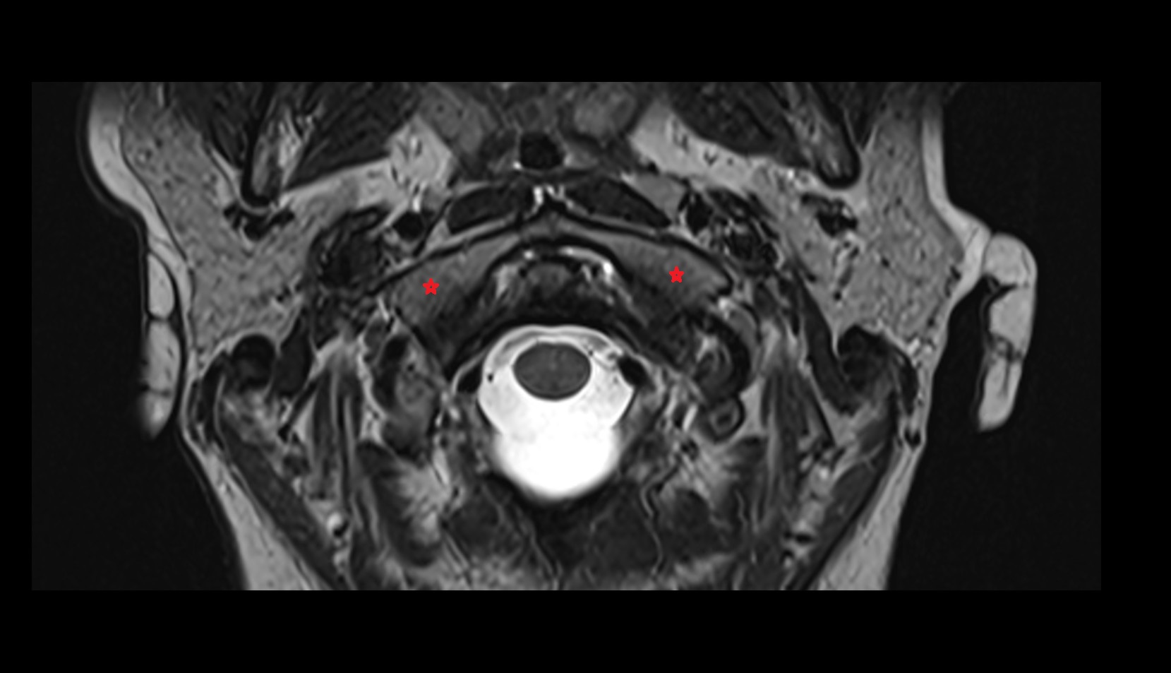 Lateral mass of atlas mri axial image
