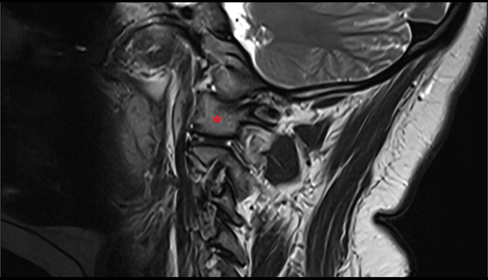 Lateral mass of atlas mri sag image