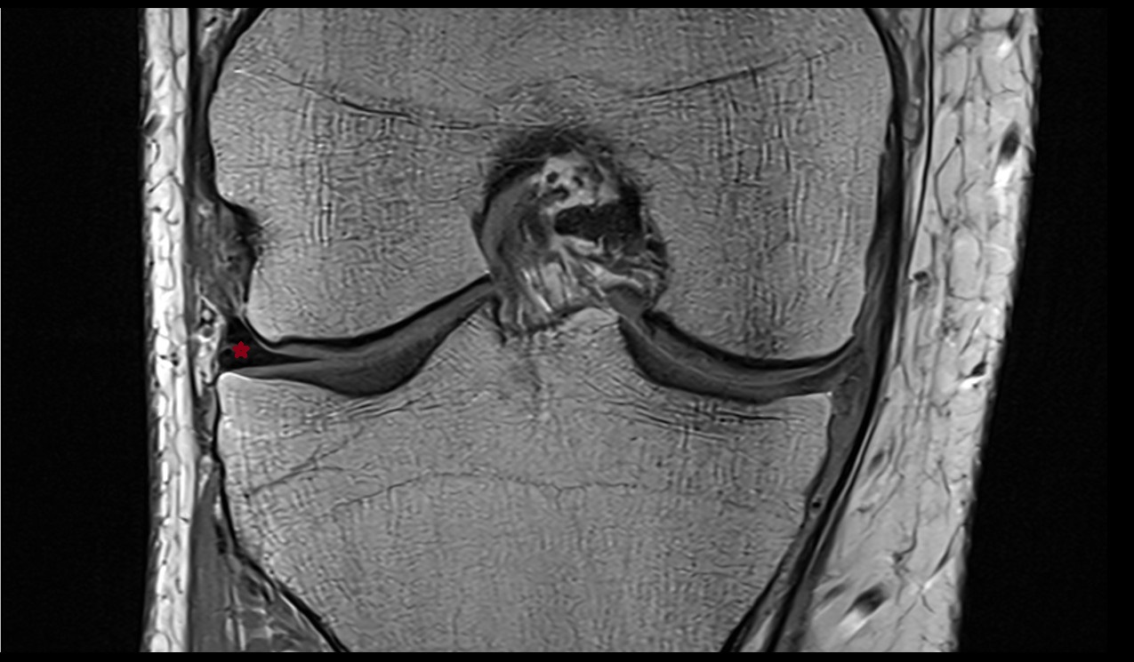 Lateral meniscus anatomy 3t mri