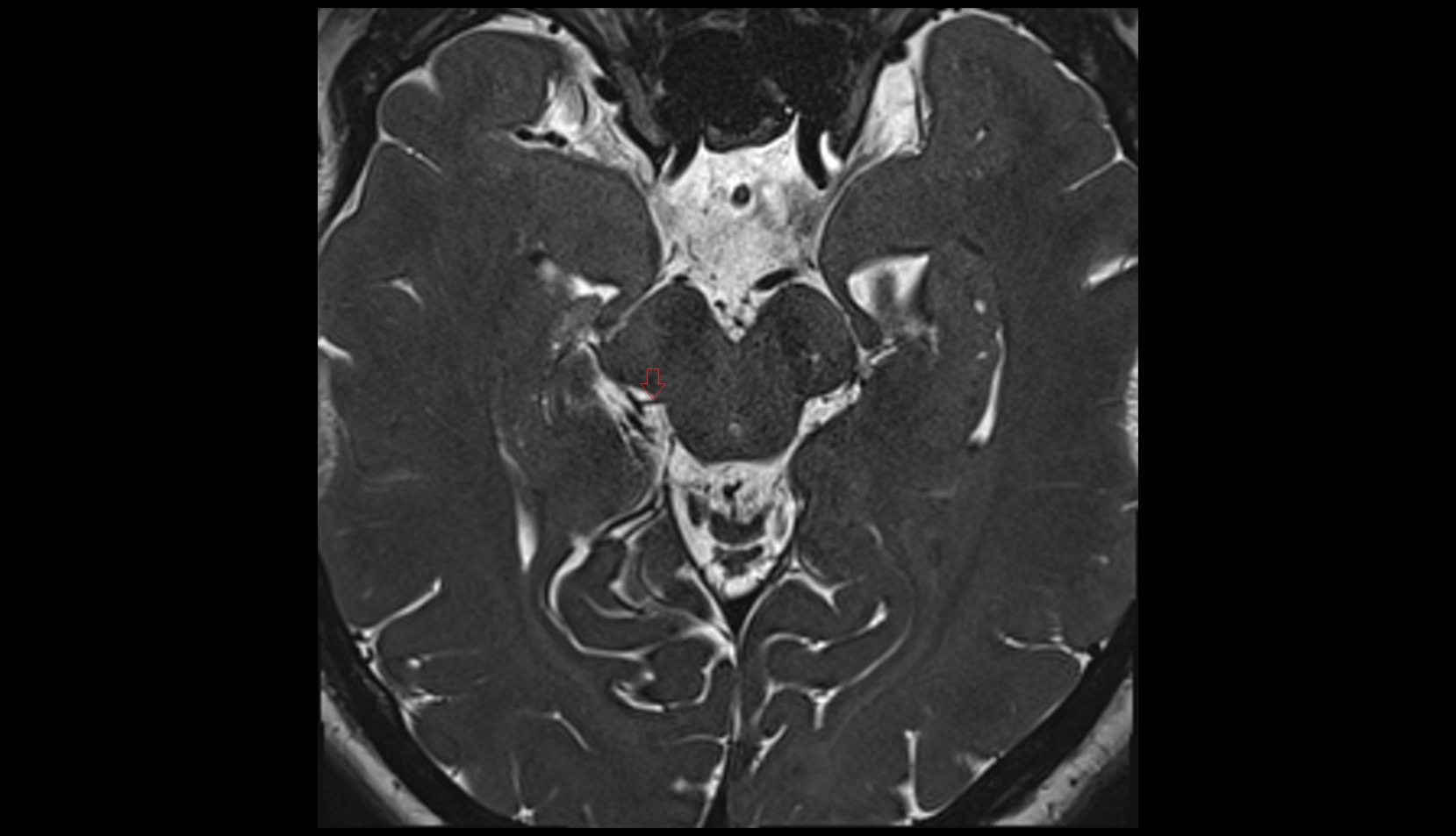 Lateral mesencephalic vein MRI 3T axial image