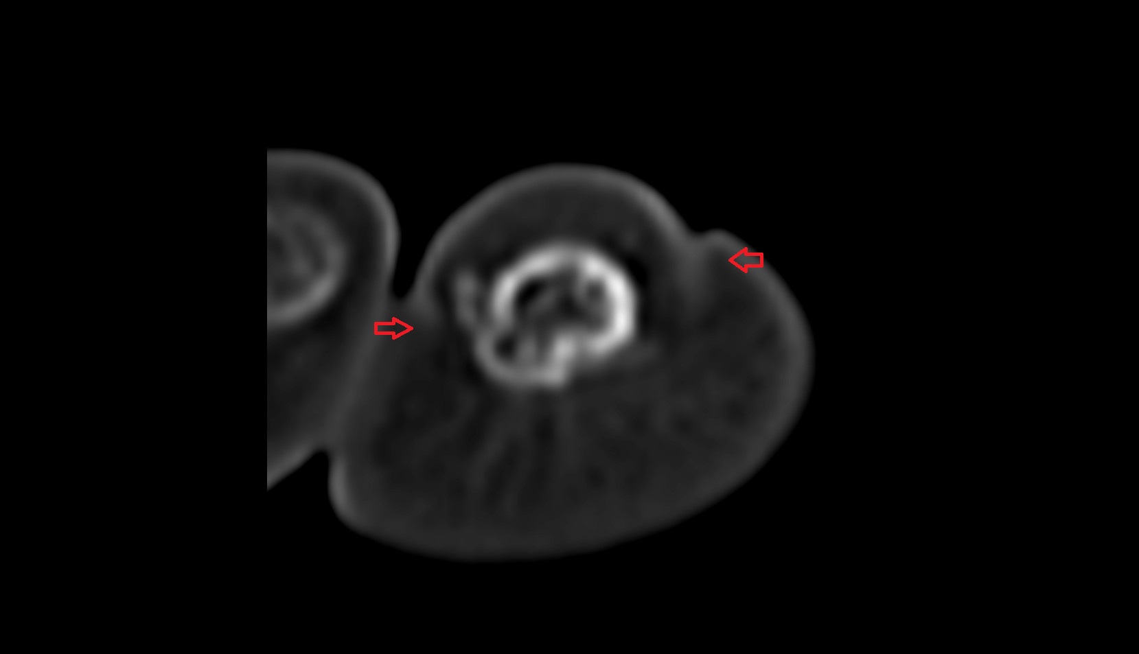 Lateral nail fold ct axial image