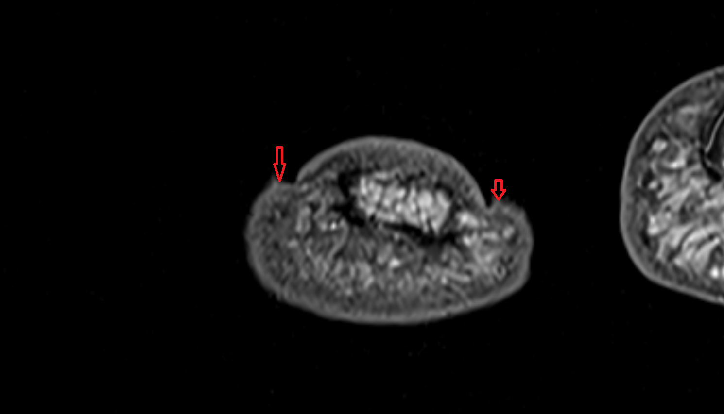 Lateral nail fold hand  MRI axial  image-img-00000-00000