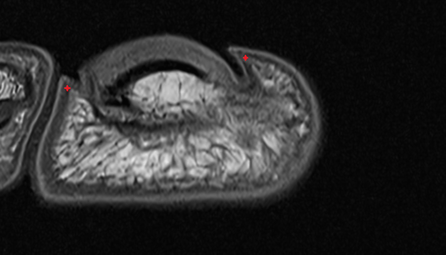 Lateral nail fold of toe axial cross sectional anatomy 3T MRI AI enhanced radiology image-img-00000-00000