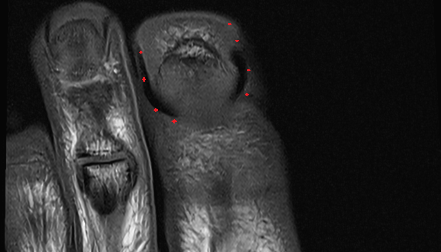 Lateral nail fold of toe coronalcross sectional anatomy 3T MRI AI enhanced radiology image-img-00000-00000