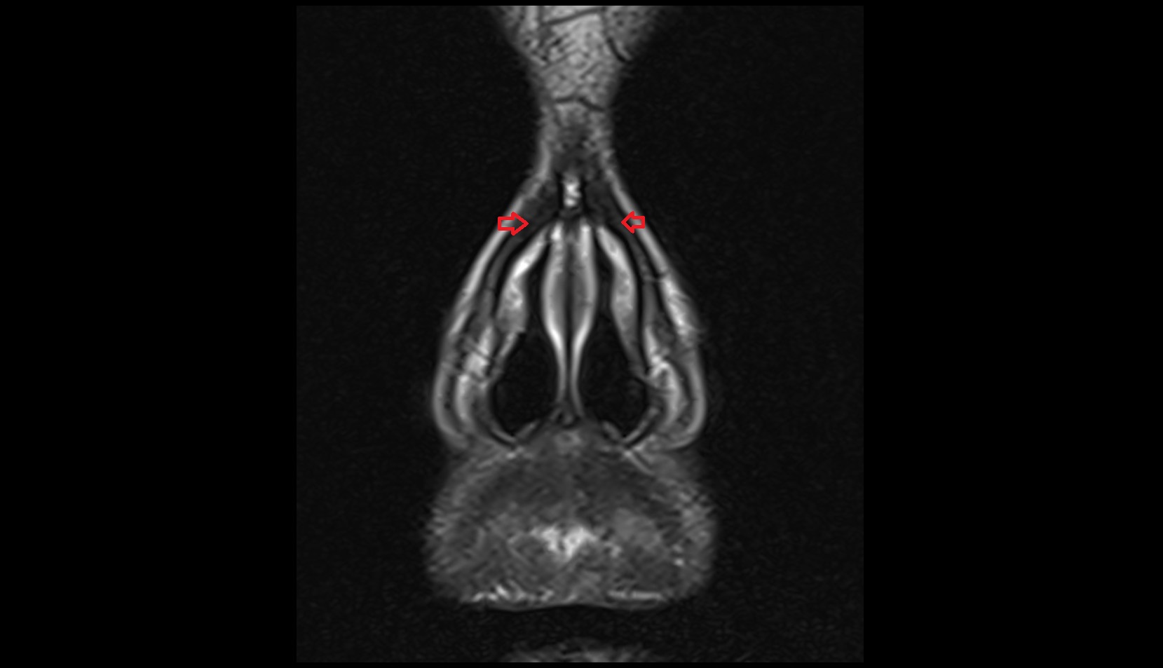 Lateral nasal cartilage