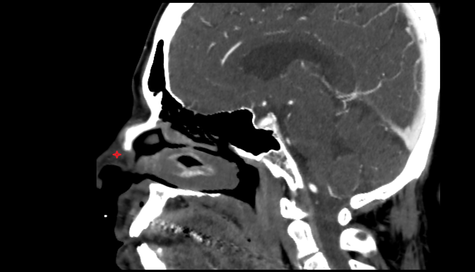 Lateral nasal cartilage CT