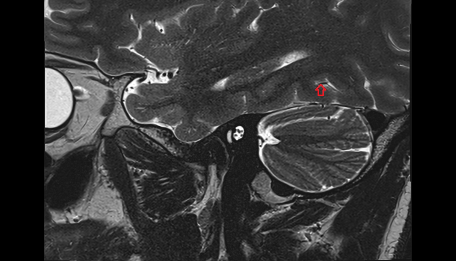 Lateral occipital artery  mri sag  image -img-00000-00000