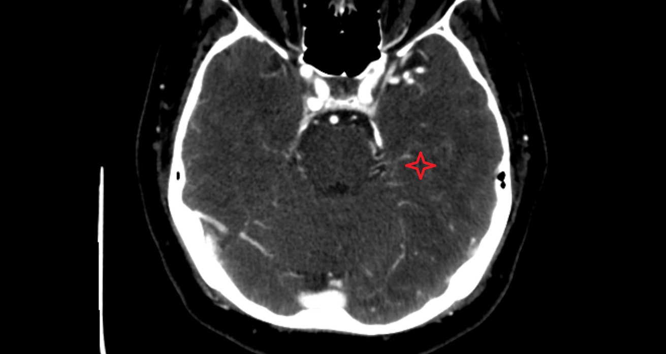Lateral occipitotemporal gyrus  CT sagittal anatomy image -img-00001-00001
