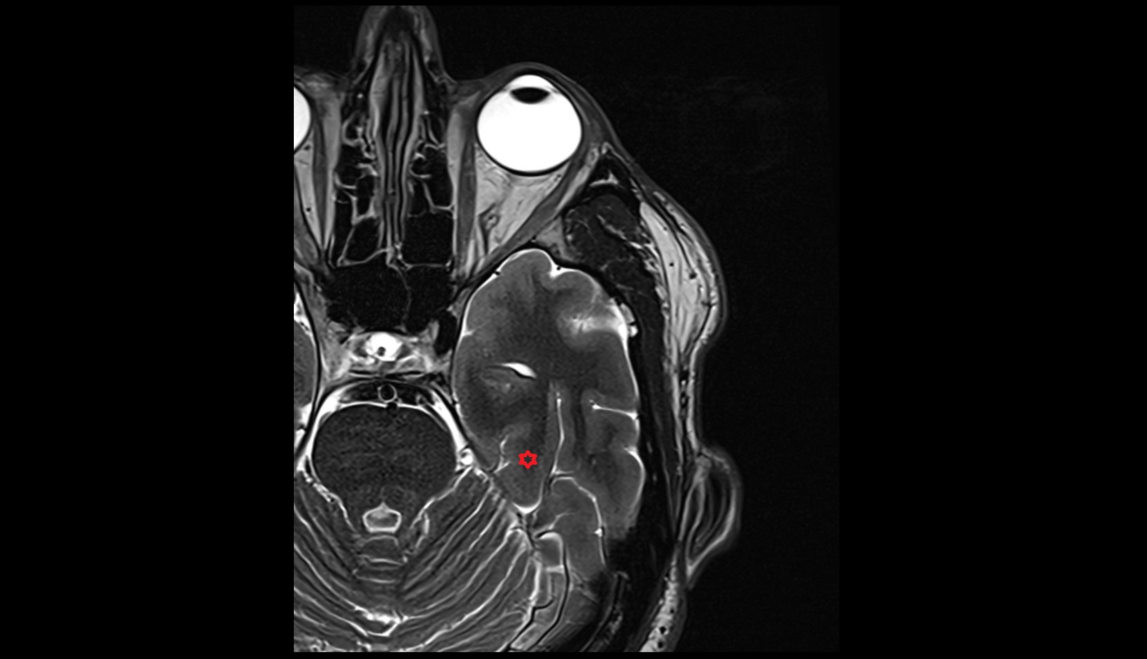 Lateral occipitotemporal gyrus mri 3t axial image