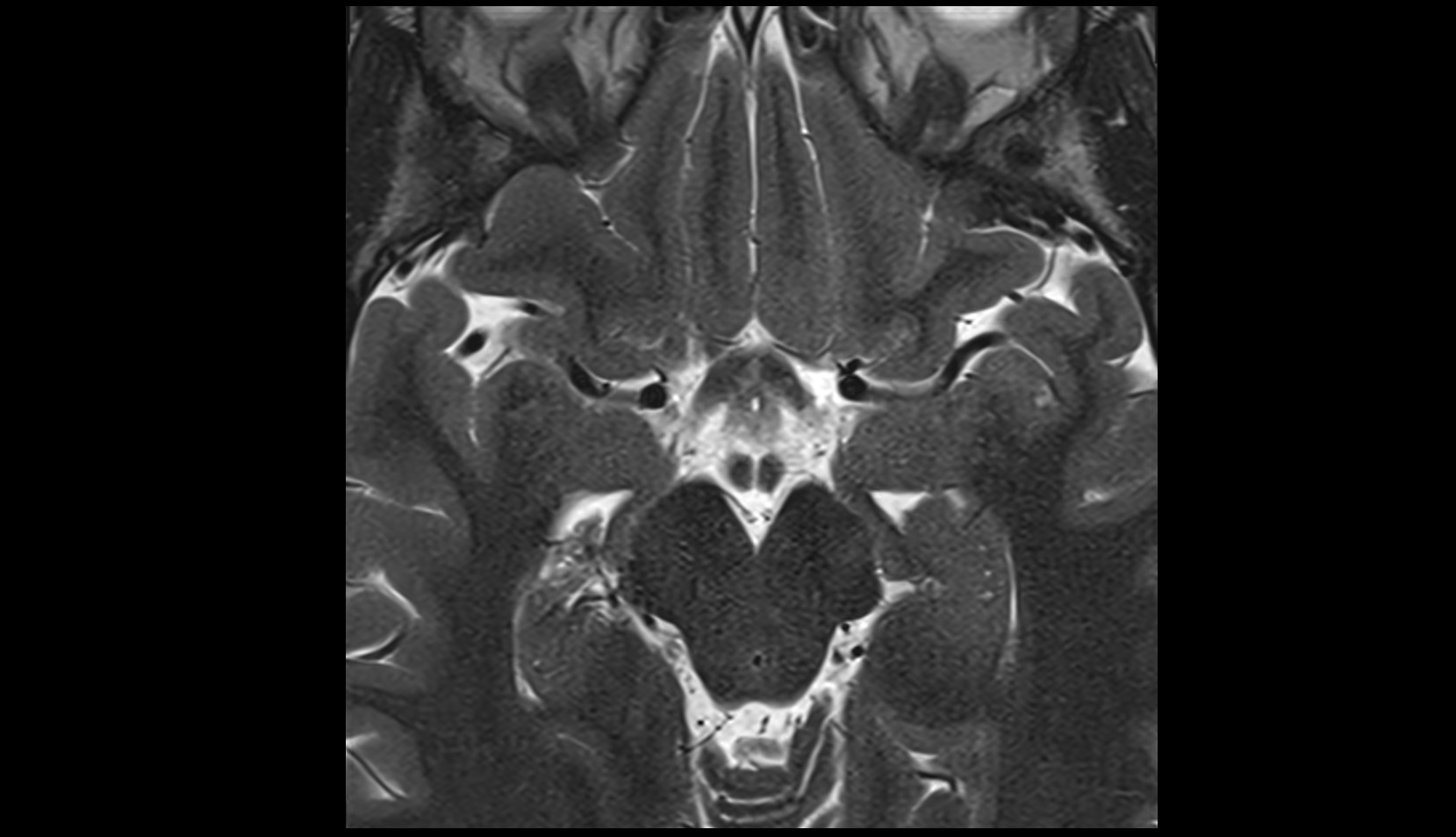 Lateral orbitofrontal artery mri axial image