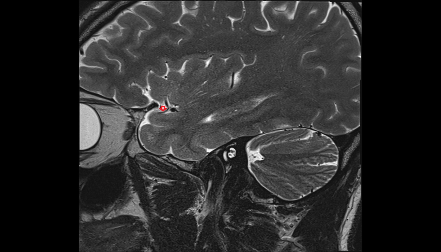 Lateral orbitofrontal artery mri sagittal  image -img-00000-00000