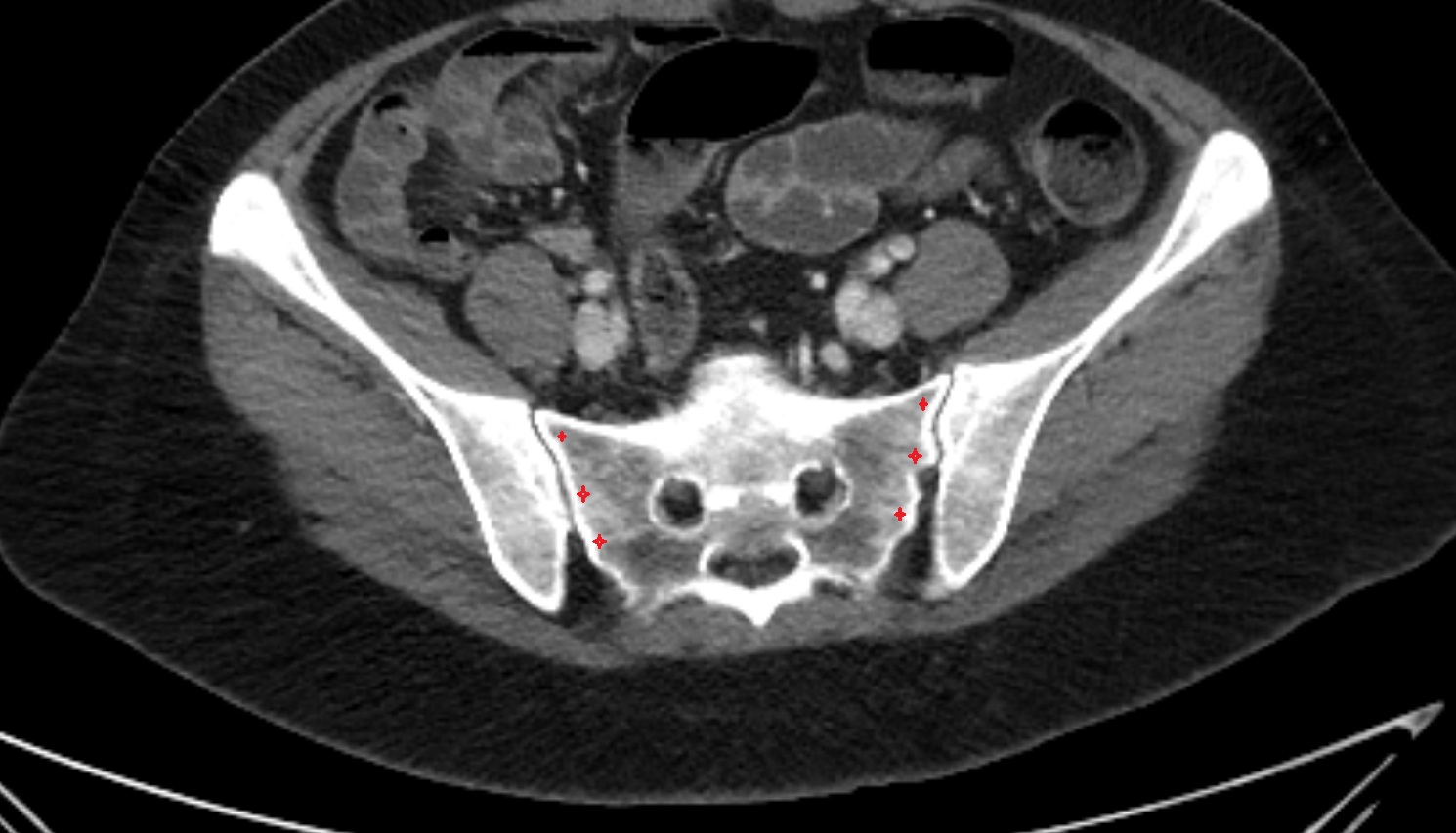 Lateral part of sacrum  CT axial  anatomy  image-img-00000-00000