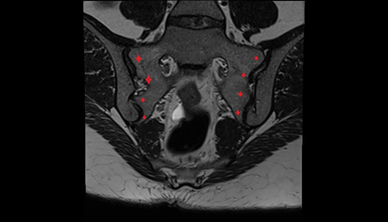 Lateral part of sacrum  MRI coronal  anatomy  image-img-00000-00000