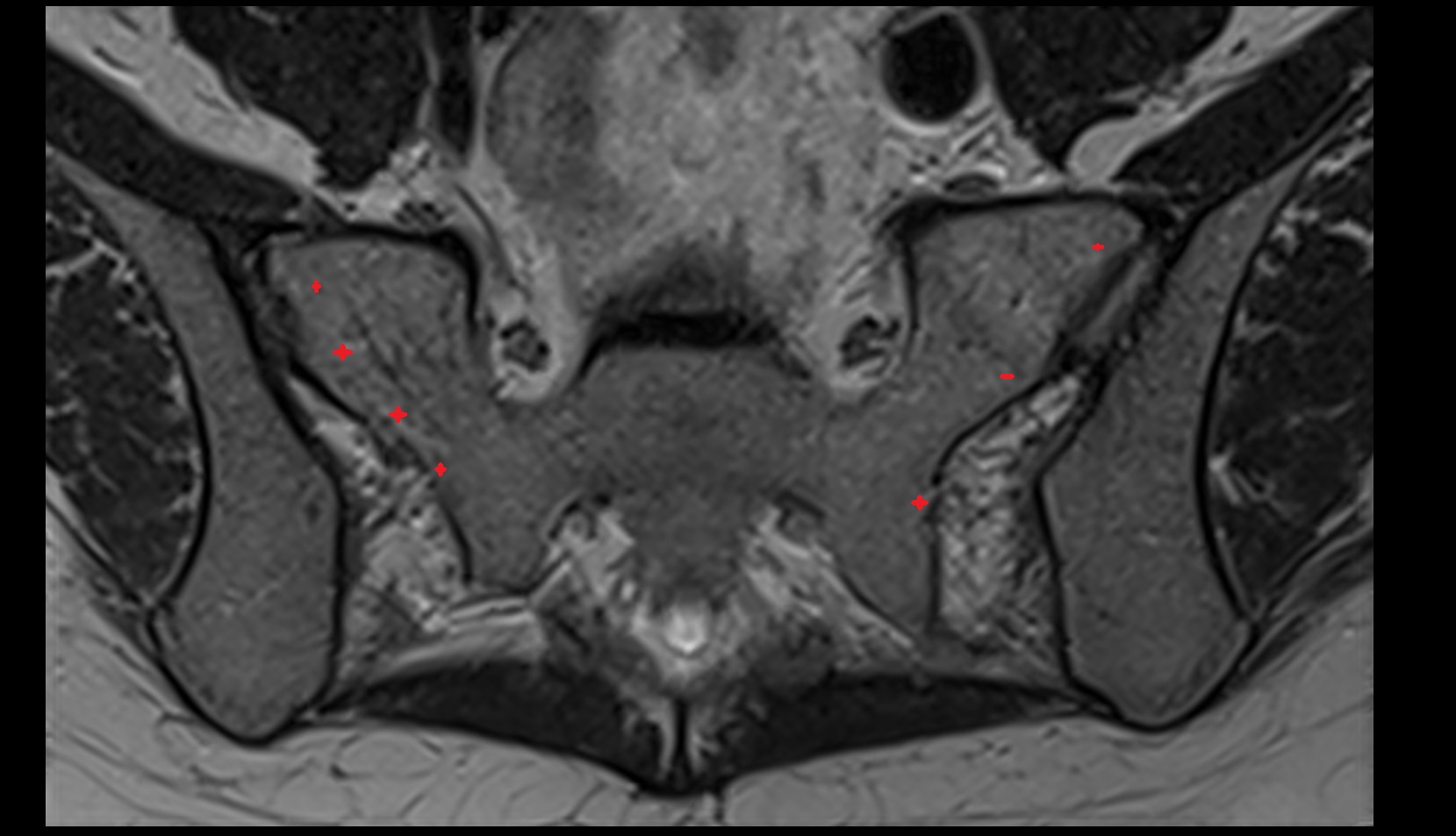 Lateral part of sacrum axial