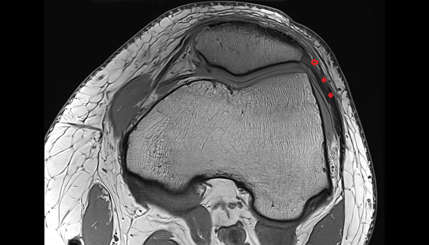 Lateral patellar retinaculum axial  cross sectional anatomy 3T MRI AI enhanced  radiology  anatomy image-img-00000-00000