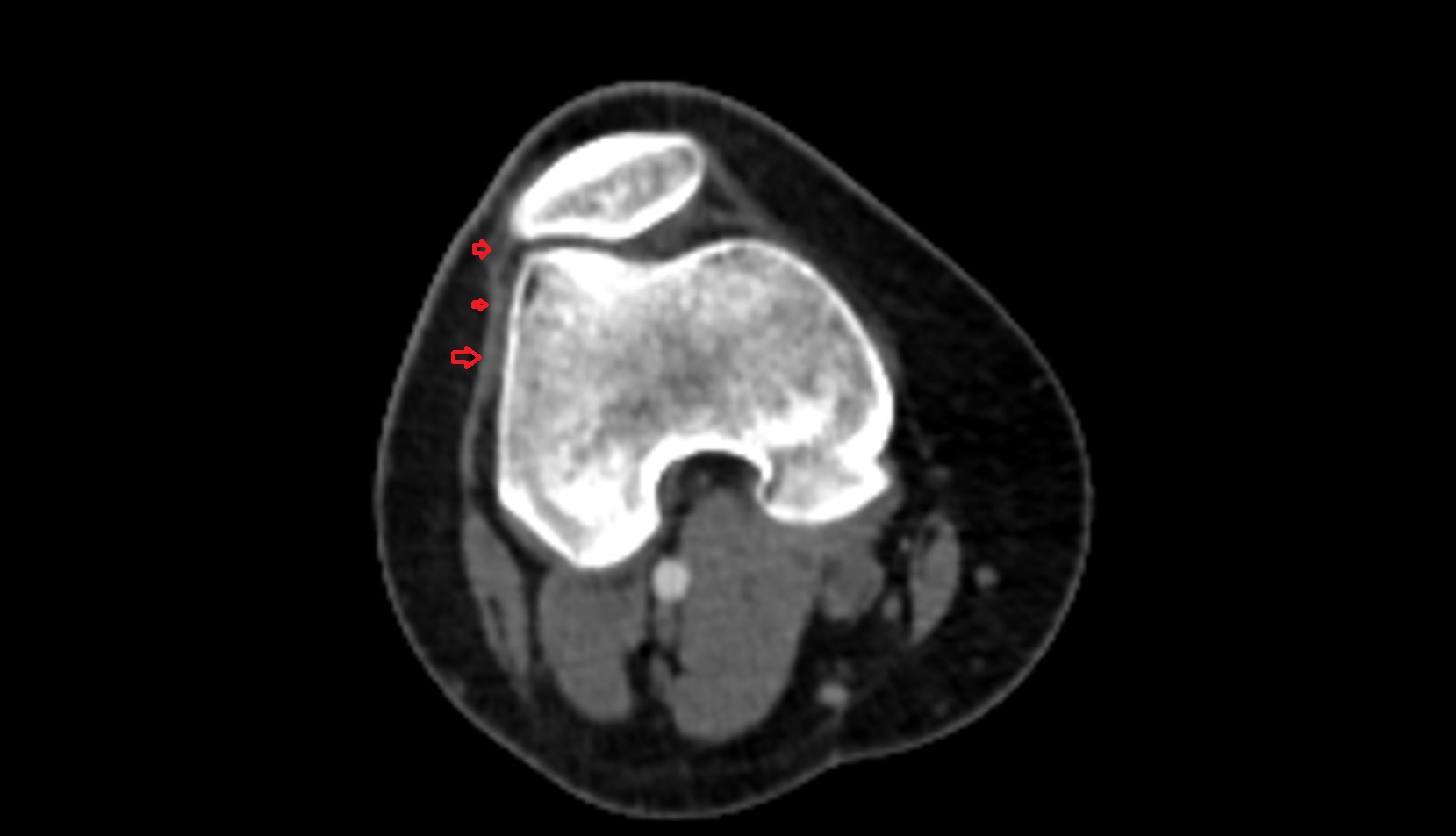 Lateral patellar retinaculum ct axial iamge