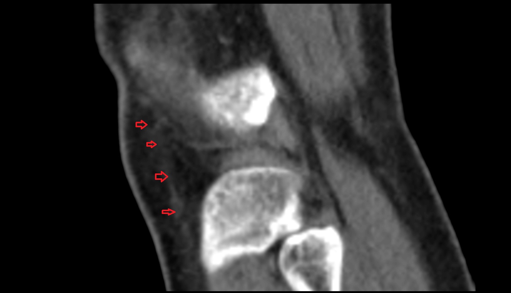 Lateral patellar retinaculum ct sagittal image