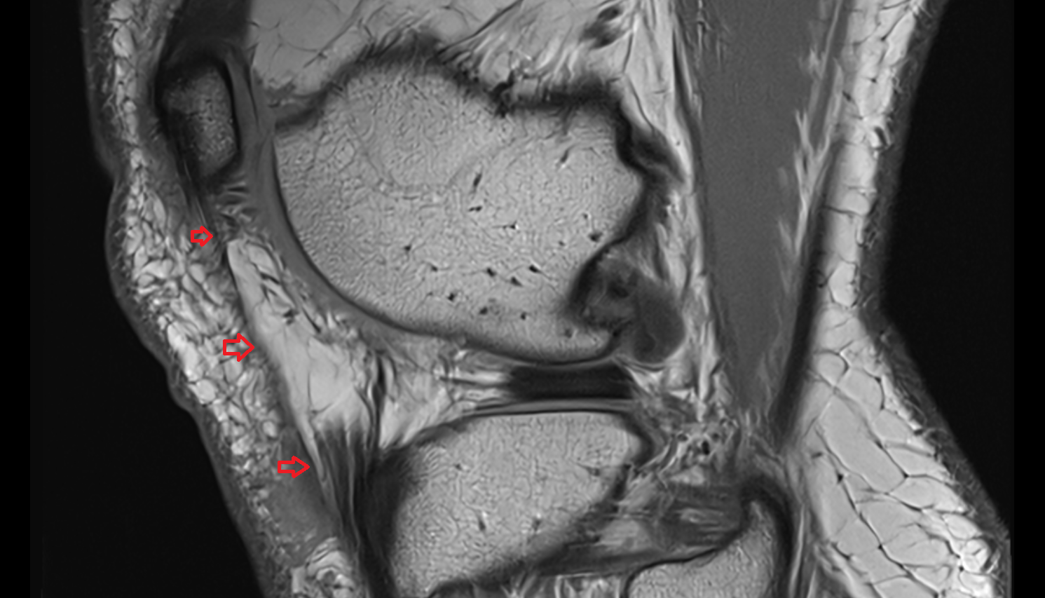 Lateral patellar retinaculum  sag  cross sectional anatomy 3T MRI AI enhanced  radiology  anatomy image-img-00000-00000