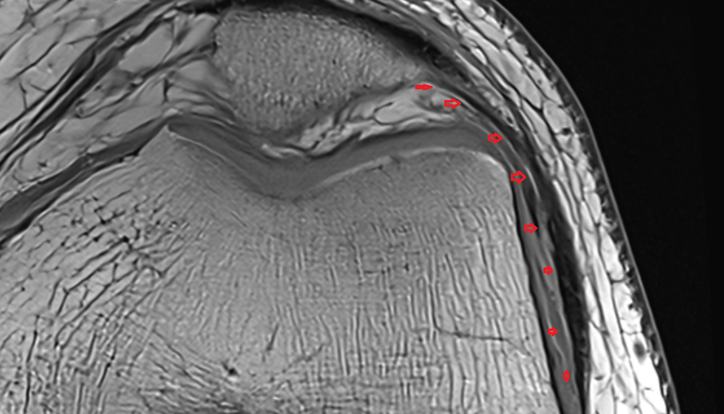 Lateral patellofemoral ligament (LPFL) axial   cross sectional anatomy 3T MRI AI enhanced  radiology  anatomy image-img-00000-00000