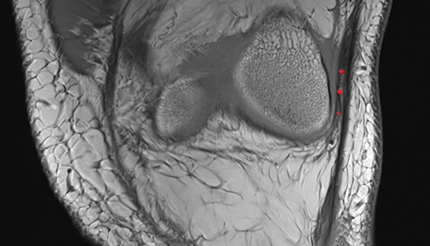 Lateral patellofemoral ligament (LPFL) coronal   cross sectional anatomy 3T MRI AI enhanced  radiology  anatomy image-img-00000-00000