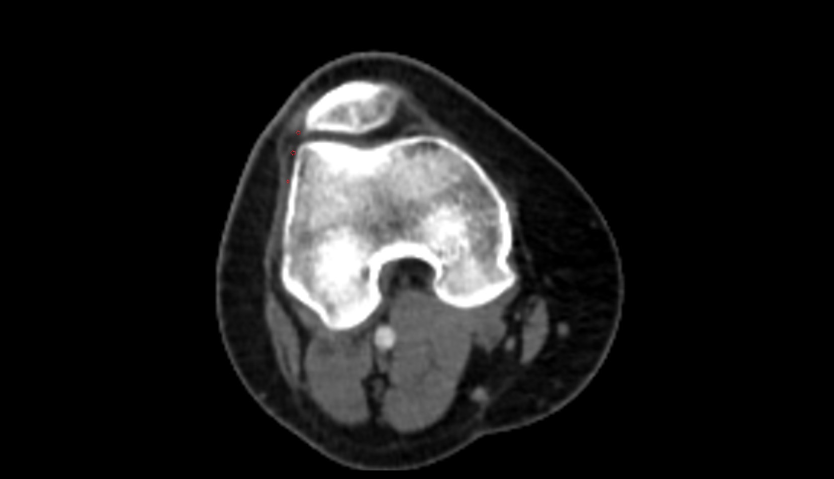 Lateral patellofemoral ligament ct axial