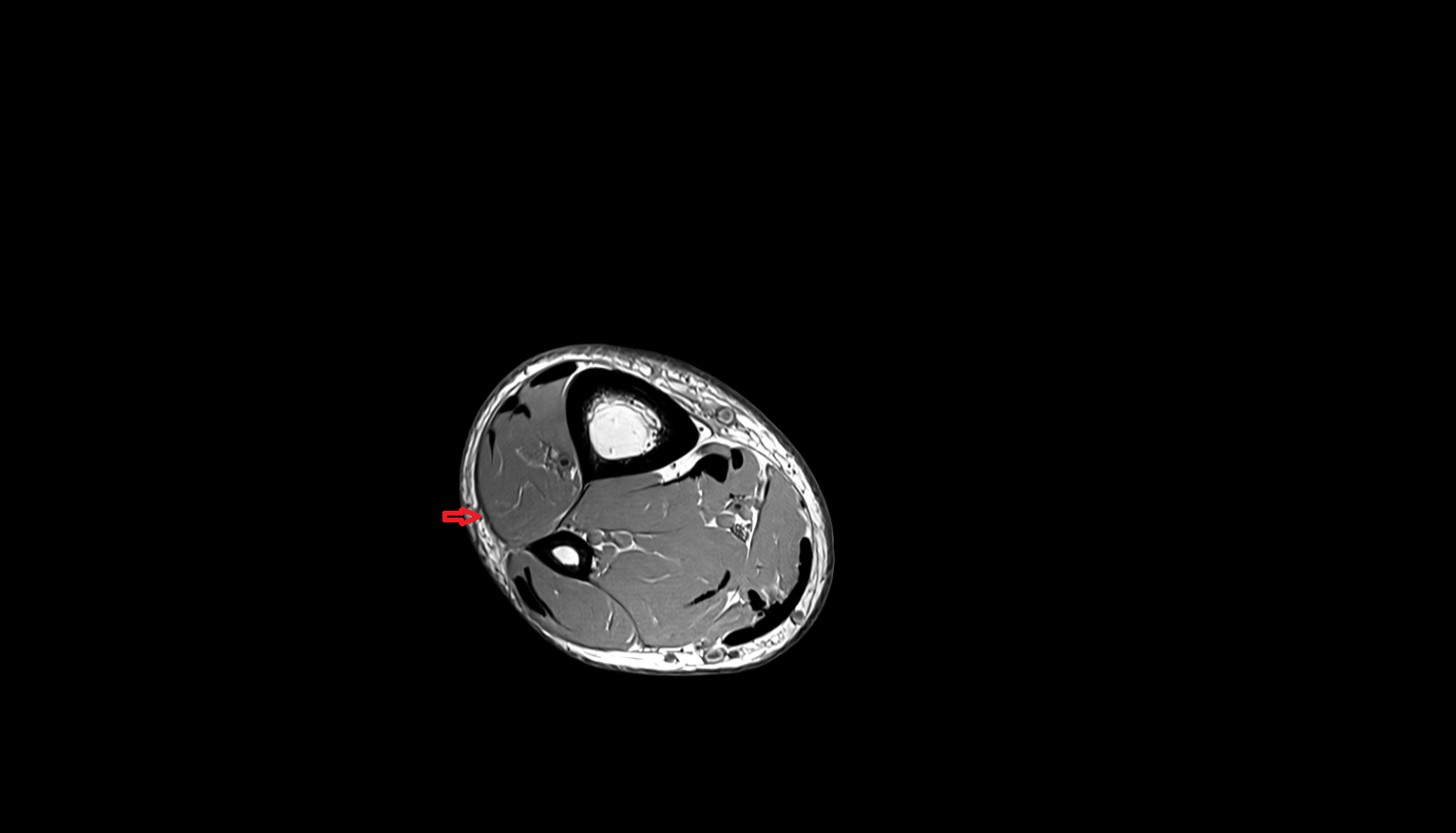 Lateral perforator veins  AXIAL  cross sectional anatomy 3T MRI AI enhanced radiology image-img-00000-00000