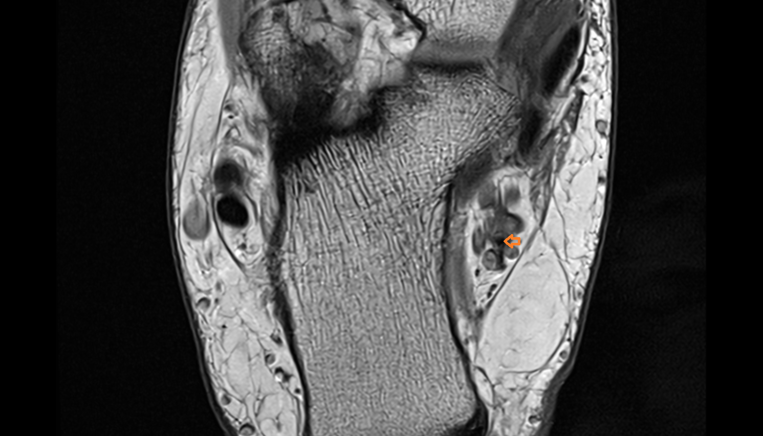 Lateral plantar artery axial  cross sectional anatomy 3T MRI AI enhanced radiology image-img-00000-00000
