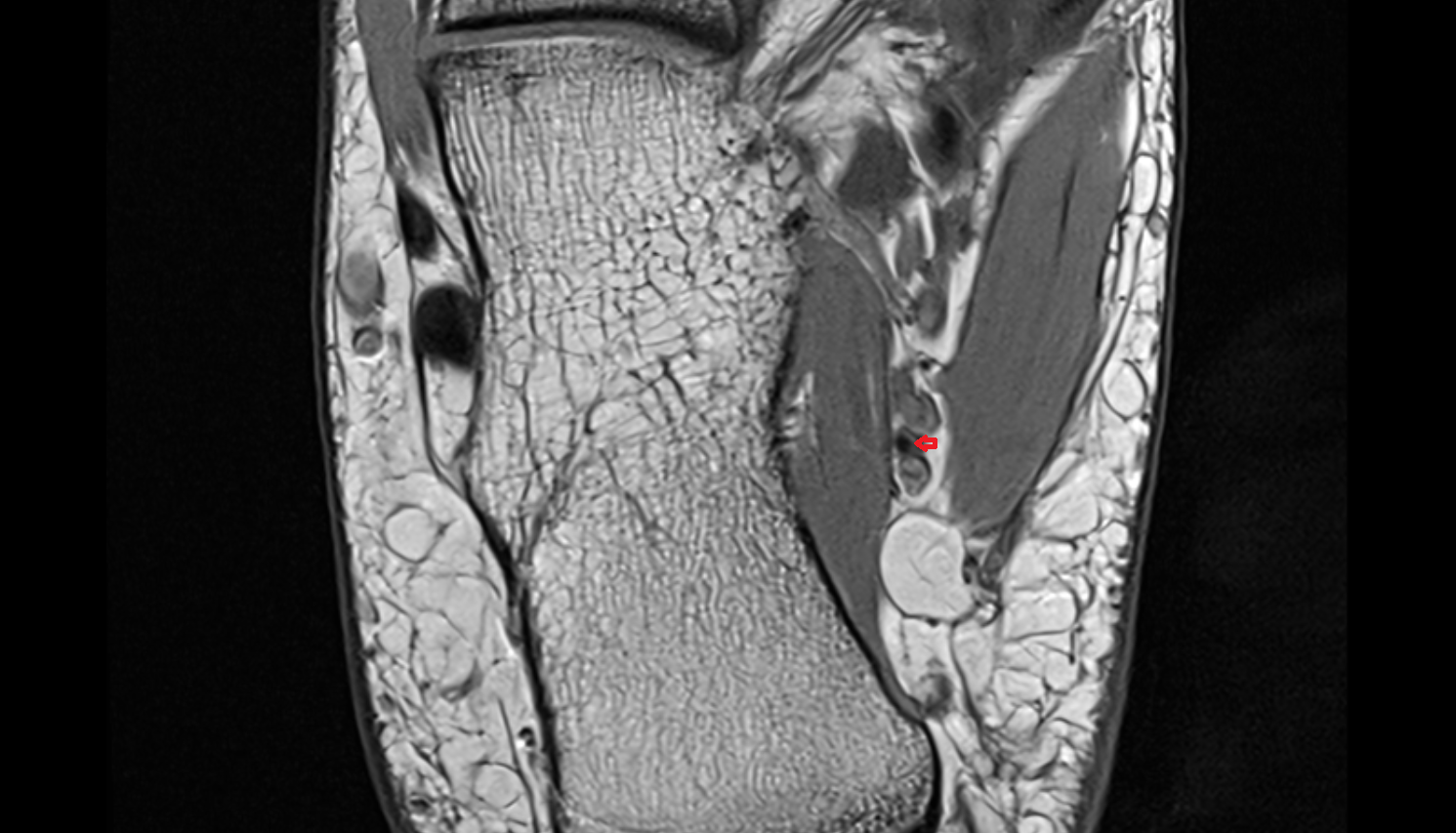 Lateral plantar artery axial  cross sectional anatomy 3T MRI AI enhanced radiology image-img-00000-00000_00001