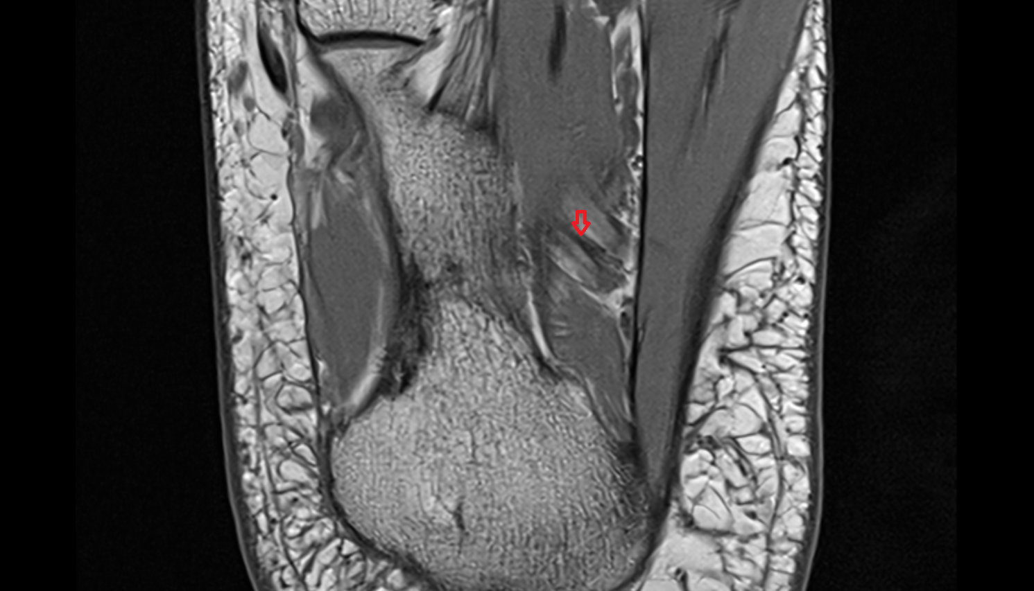 Lateral plantar artery axial  cross sectional anatomy 3T MRI AI enhanced radiology image-img-00000-00000_00002