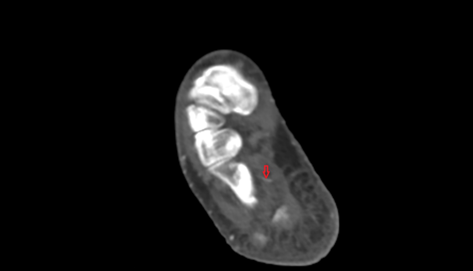 Lateral plantar artery ct axial 2