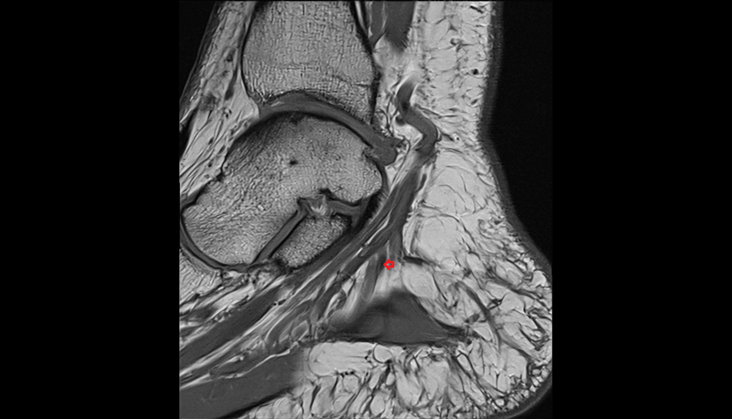 Lateral plantar artery sag  cross sectional anatomy 3T MRI AI enhanced radiology image-img-00000-00000