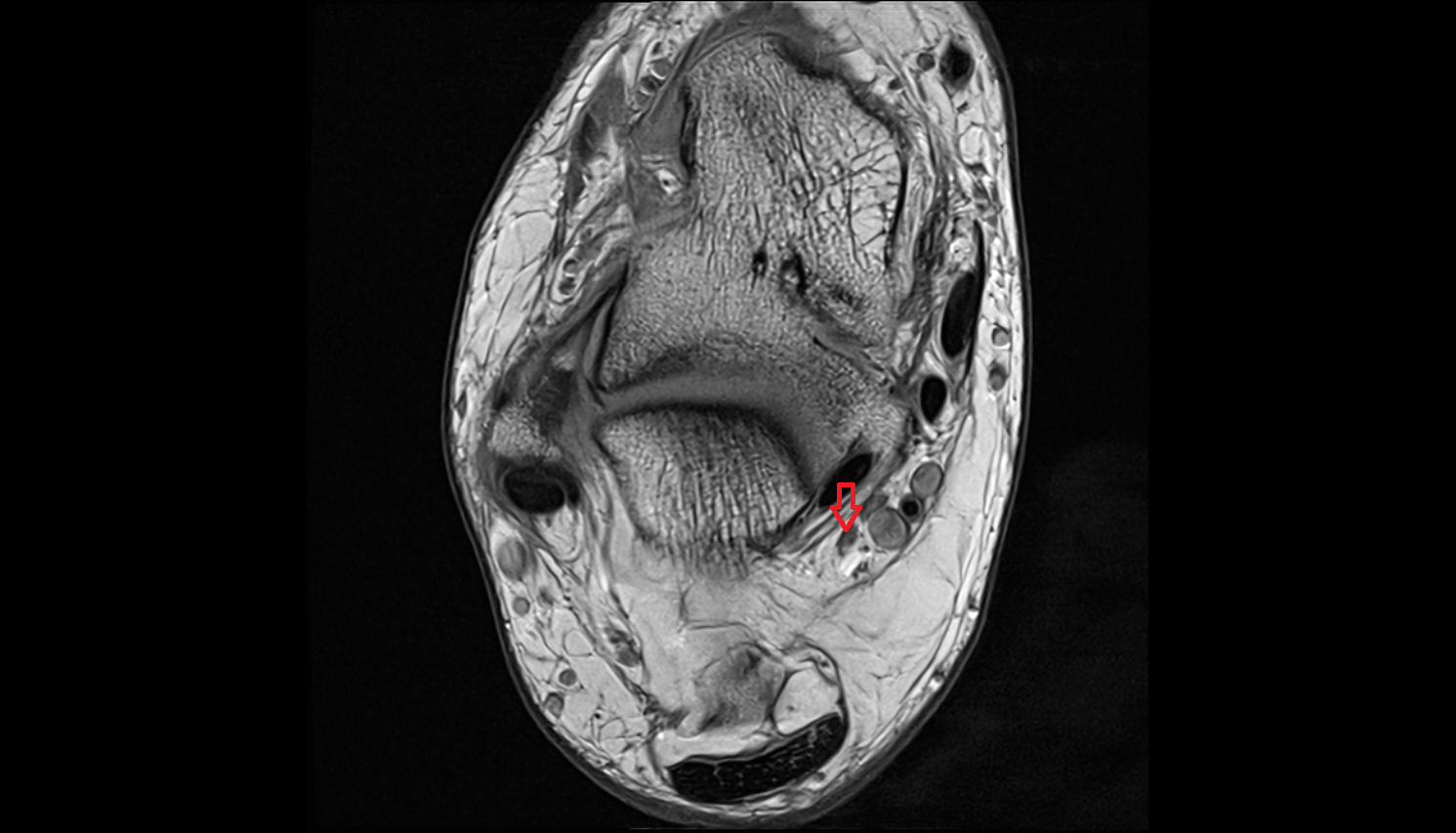 Lateral plantar nerve axial  cross sectional anatomy 3T MRI AI enhanced radiology image-img-00000-00000