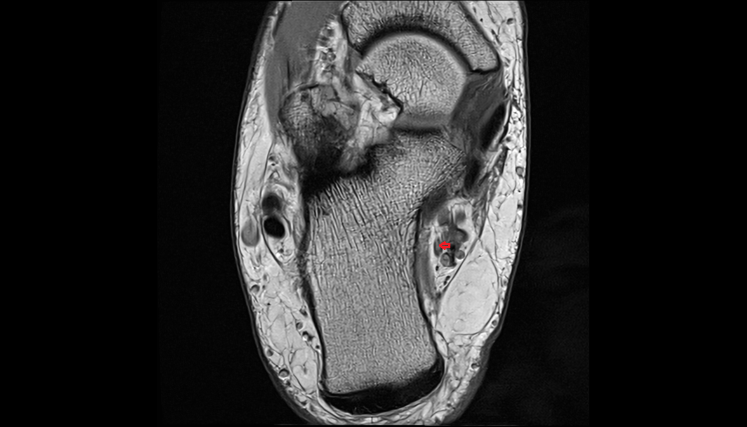 Lateral plantar nerve axial  cross sectional anatomy 3T MRI AI enhanced radiology image-img-00000-00000_00001