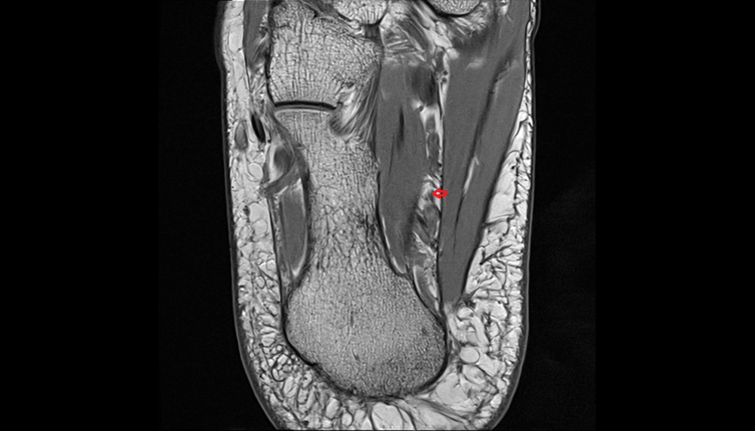 Lateral plantar nerve axial  cross sectional anatomy 3T MRI AI enhanced radiology image-img-00000-00000_00002