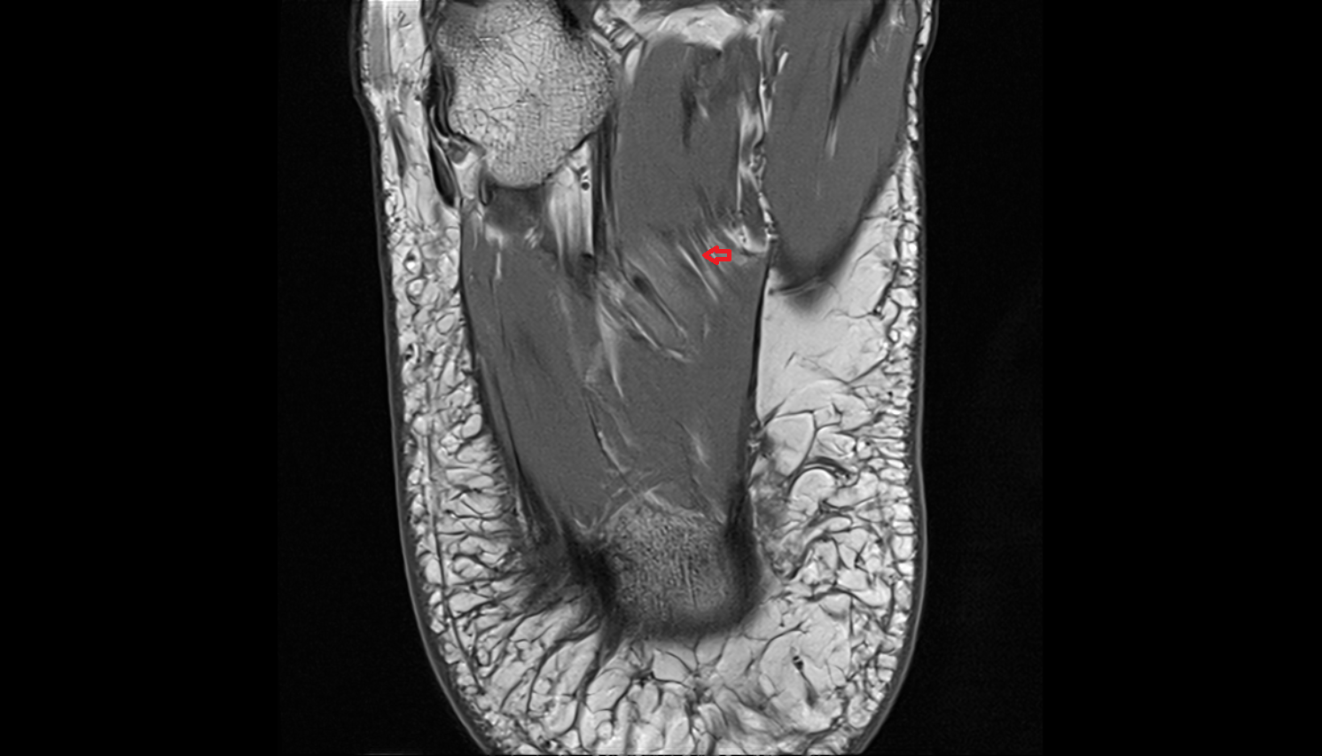 Lateral plantar nerve axial  cross sectional anatomy 3T MRI AI enhanced radiology image-img-00000-00000_00003