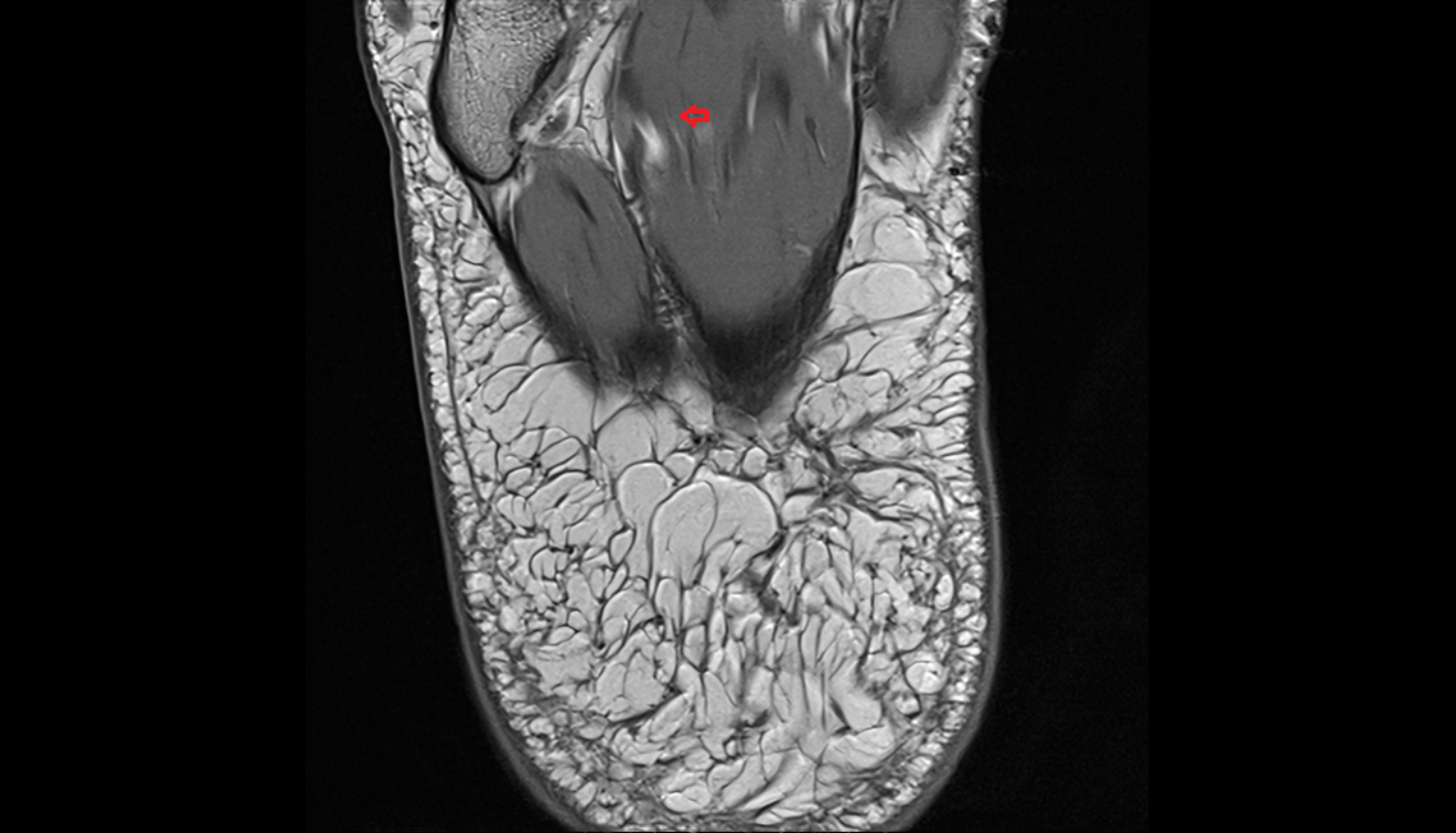 Lateral plantar nerve axial  cross sectional anatomy 3T MRI AI enhanced radiology image-img-00000-00000_00004