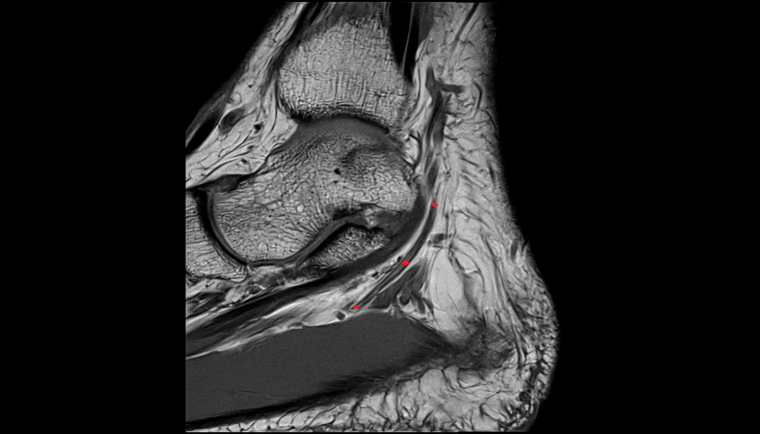 Lateral plantar nerve  sag cross sectional anatomy 3T MRI AI enhanced radiology image-img-00000-00000