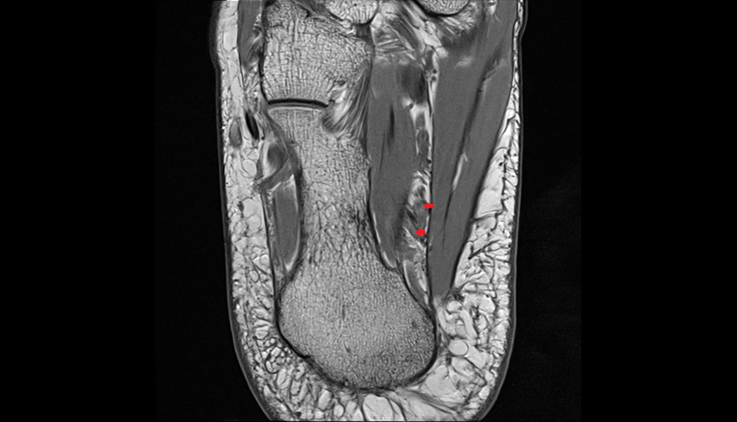 Lateral plantar veins  AXIAL  cross sectional anatomy 3T MRI AI enhanced radiology image-img-00000-00000_00001