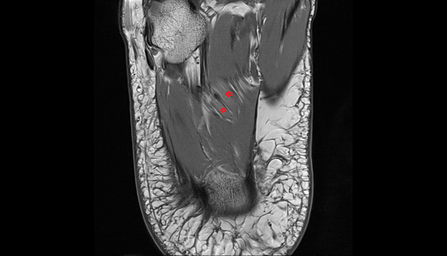 Lateral plantar veins  AXIAL  cross sectional anatomy 3T MRI AI enhanced radiology image-img-00000-00000_00002