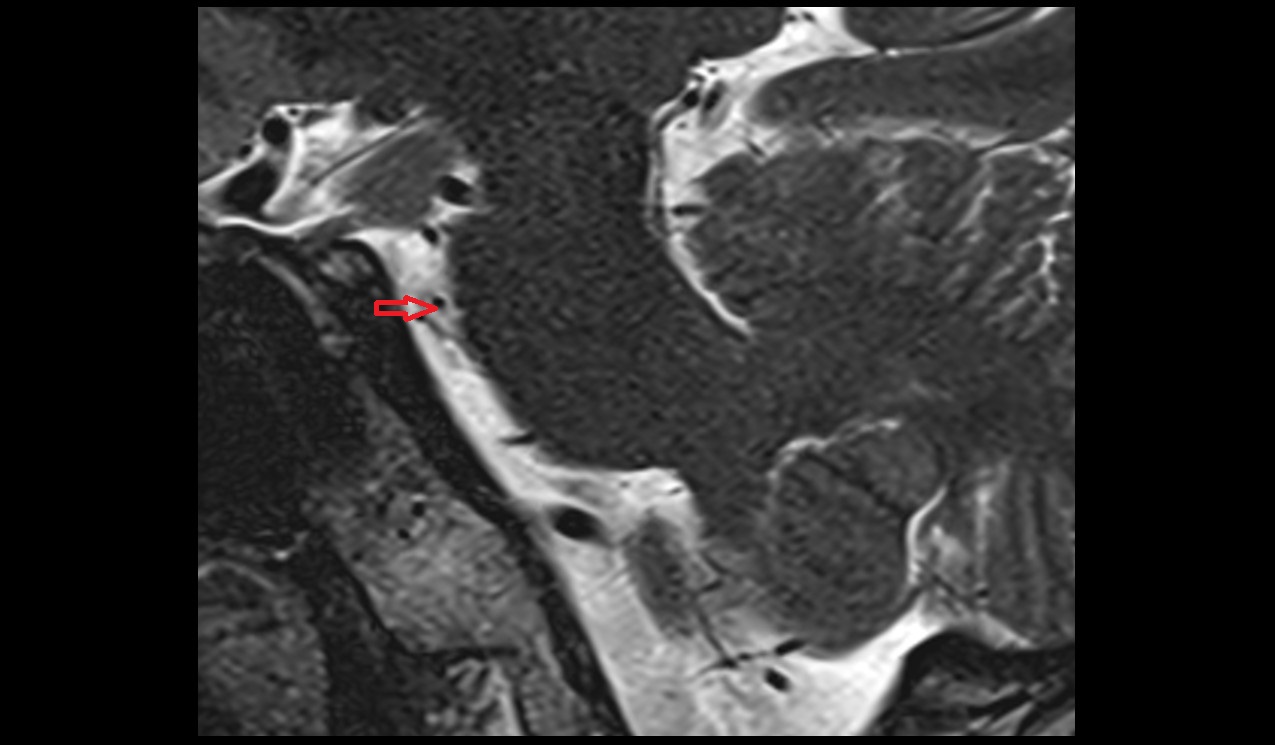 Lateral pontine vein MRI 3T sagittal image