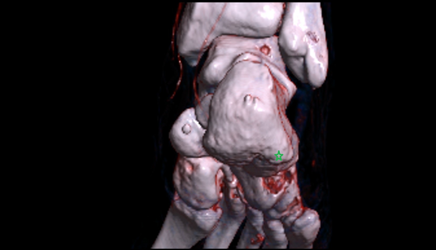Lateral process of calcaneal tuberosity 3d