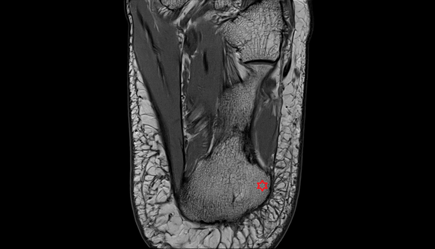 Lateral process of calcaneal tuberosity  mri  anatomy labelled image-img-00000-00000