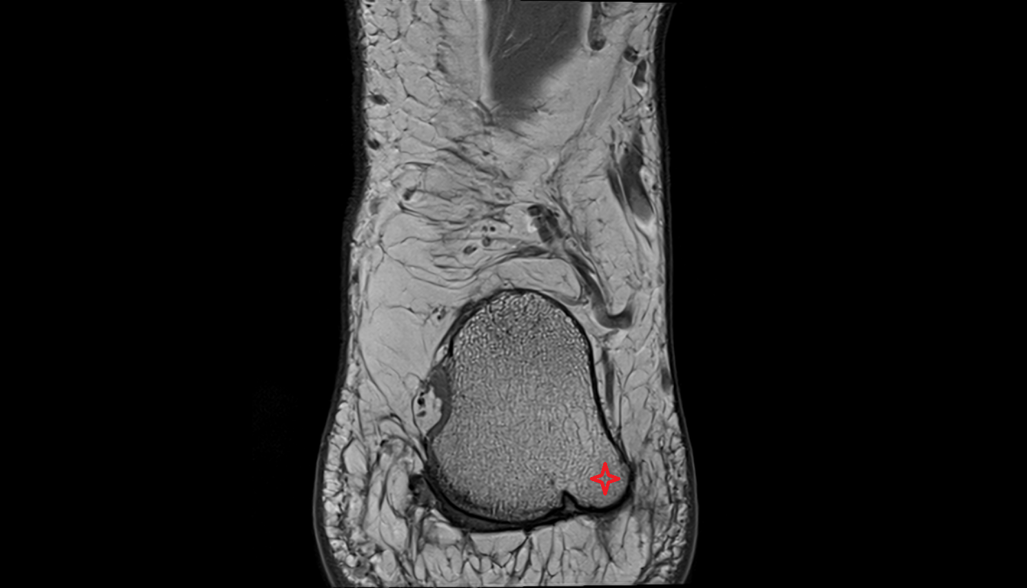 Lateral process of calcaneal tuberosity  mri  anatomy labelled image-img-00000-00000_00001