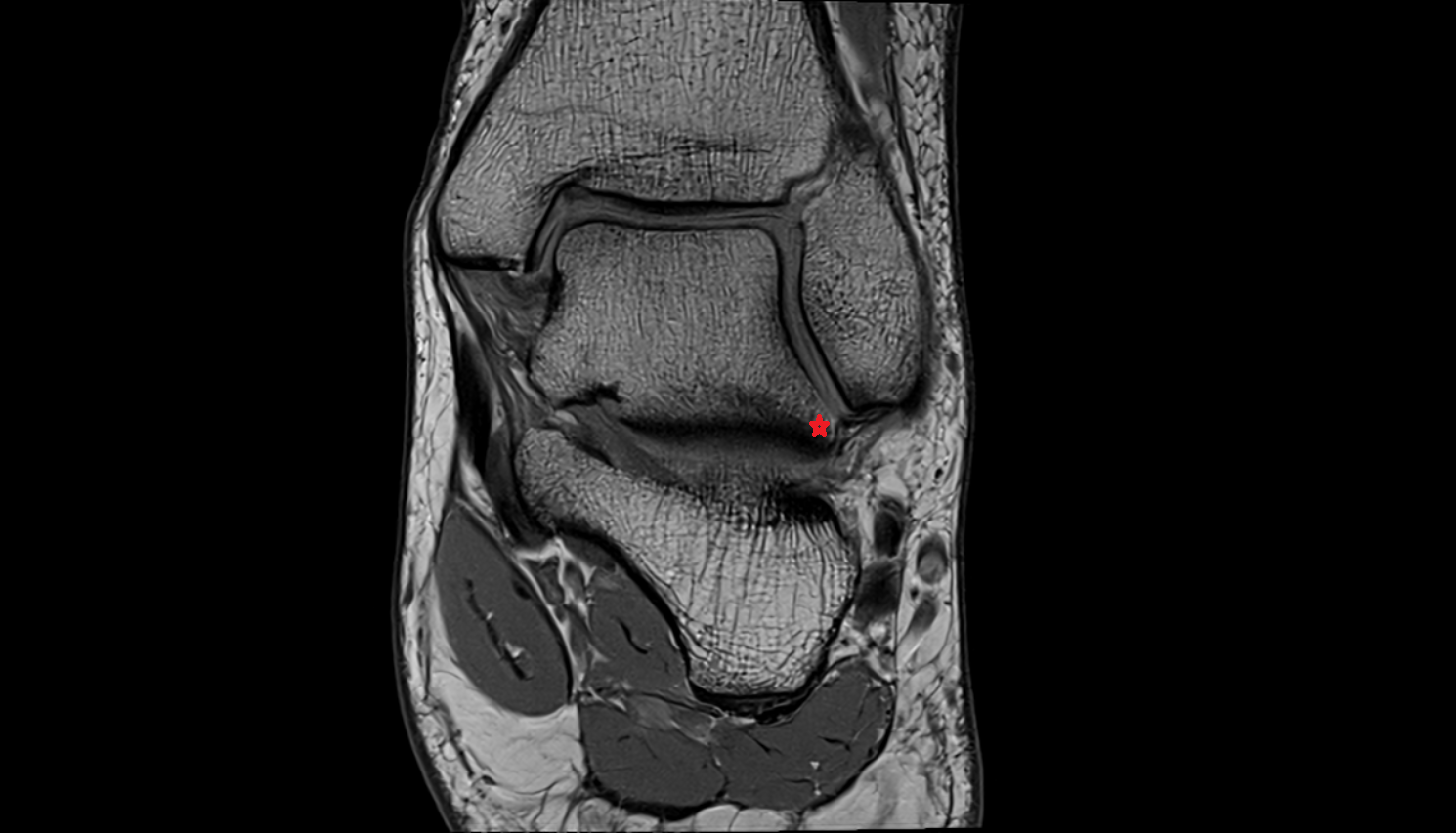 Lateral process of talus  mri  anatomy labelled image-img-00000-00000