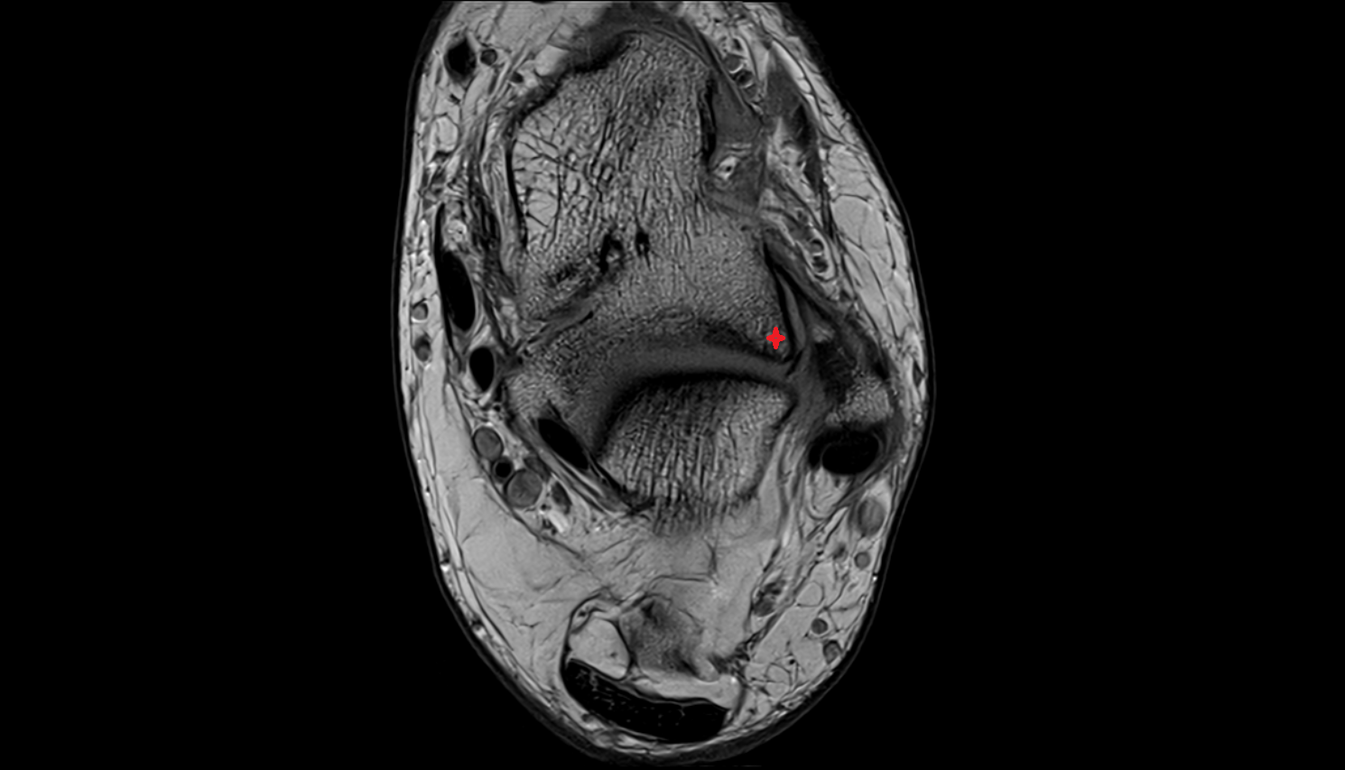 Lateral process of talus  mri  anatomy labelled image-img-00000-00000_00001