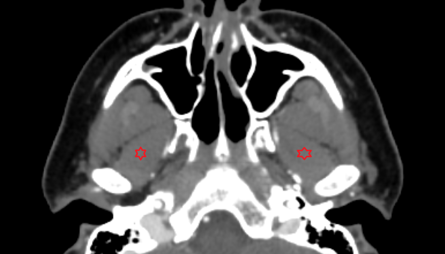 Lateral pterygoid muscle CT axial  image-img-00000-00000