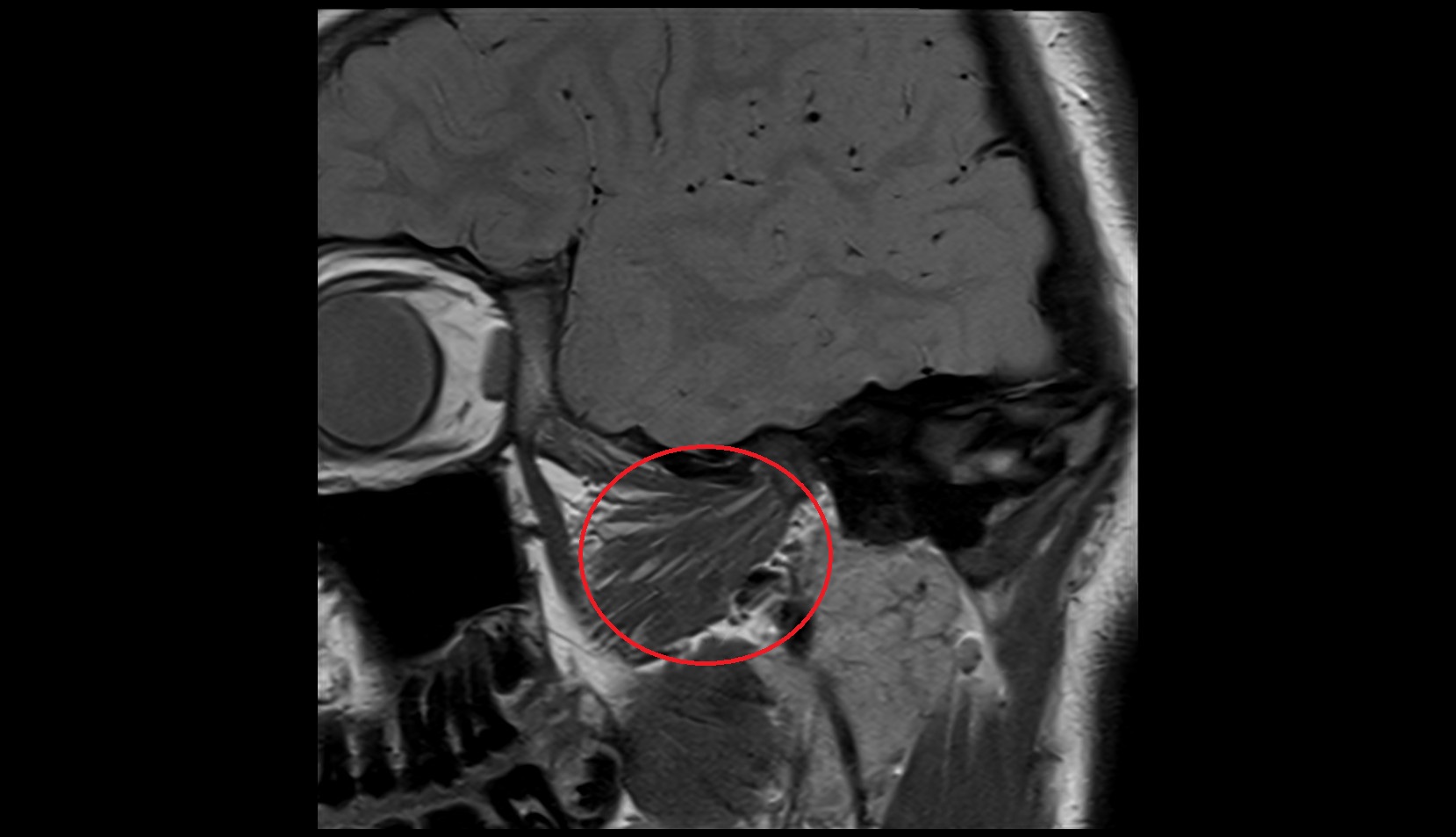 Lateral pterygoid muscle mri image