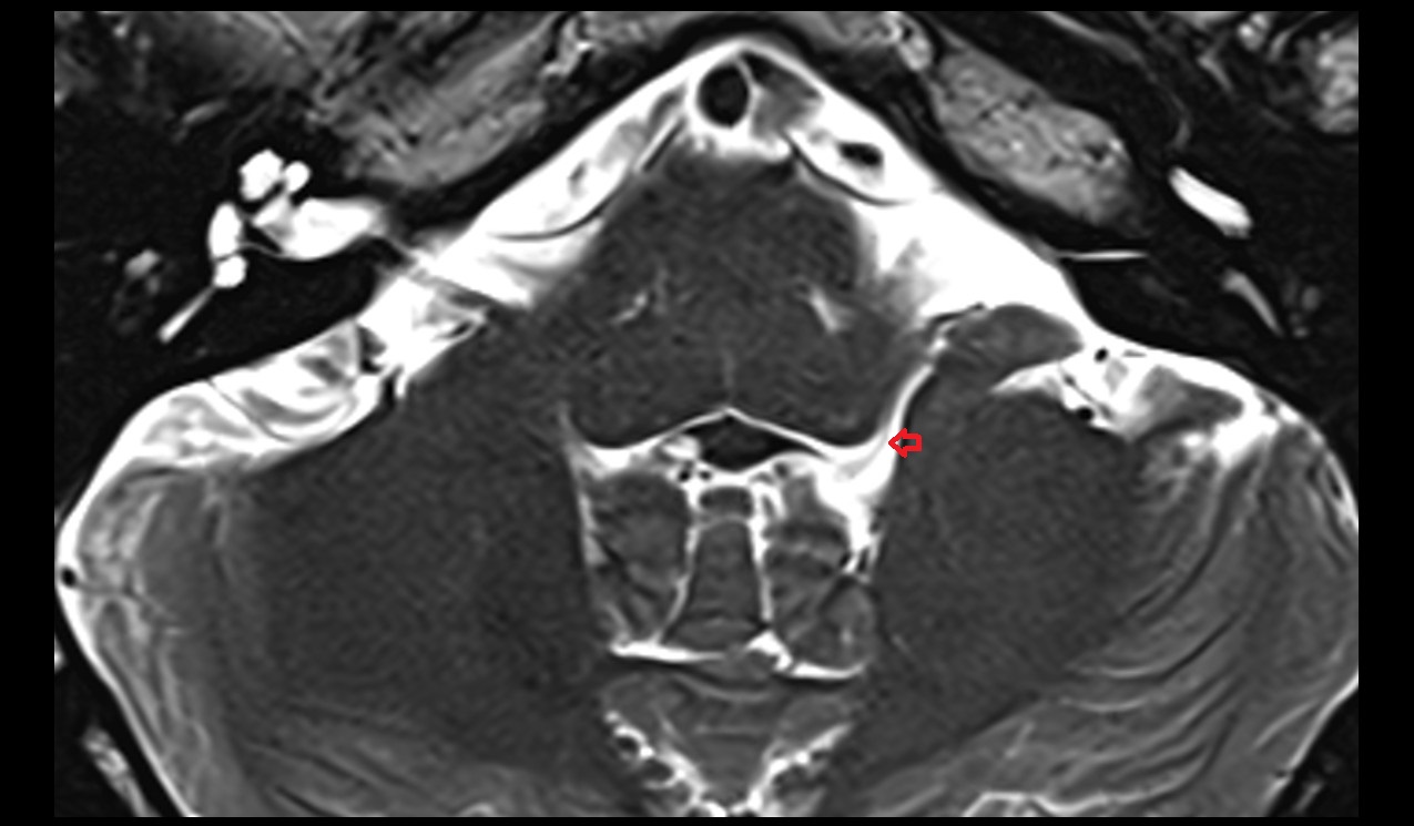 Lateral recess of fourth ventricle mri 3t axial image