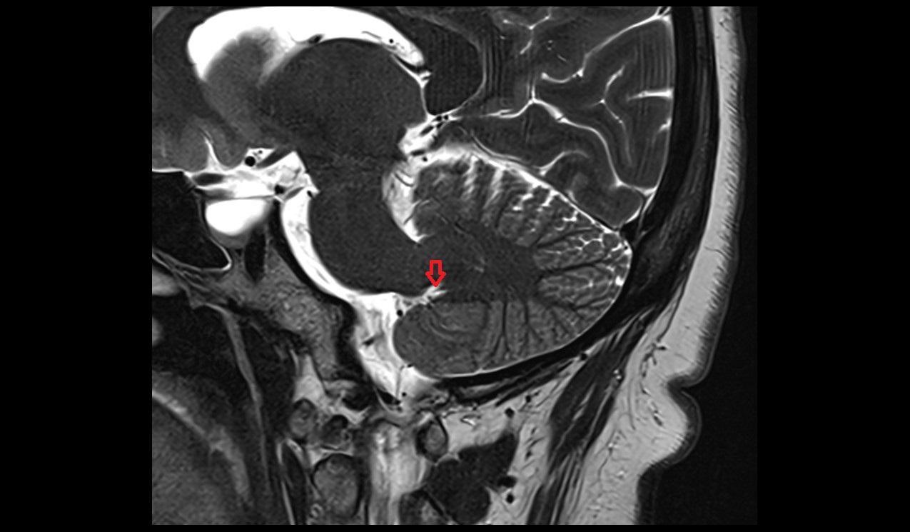 Lateral recess of fourth ventricle mri 3t sagittal image