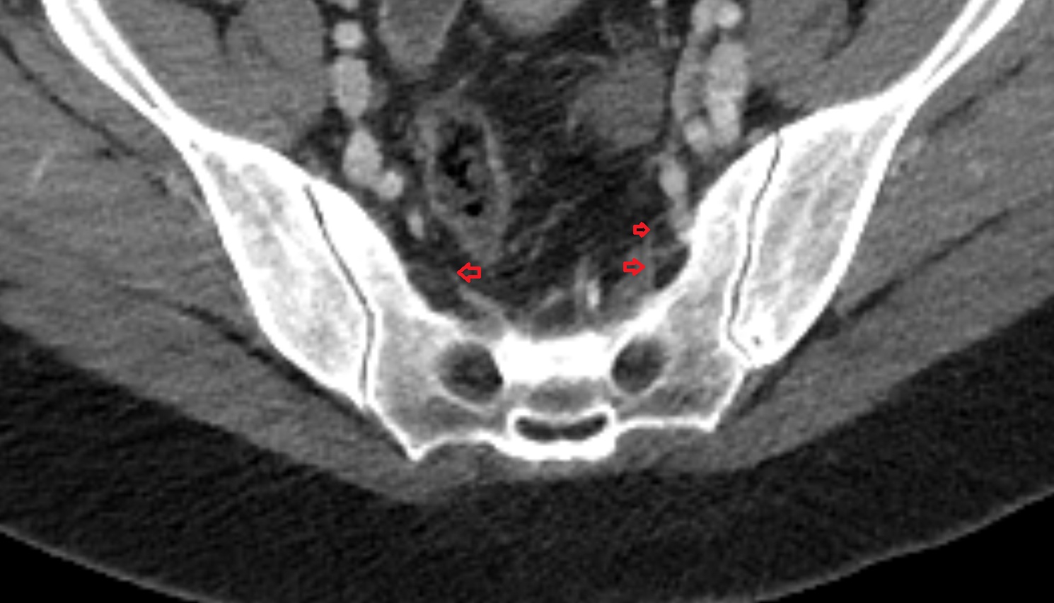 Lateral sacral artery ct axial  anatomy  image-img-00000-00000